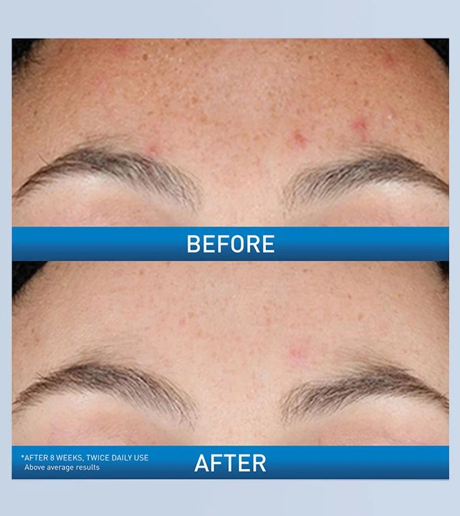 CeraVe Resurfacing Retinol Face Serum with Ceramides & Niacinamide for Blemish-Prone Skin 30ml
