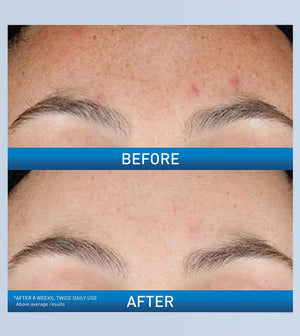 CeraVe Resurfacing Retinol Face Serum with Ceramides & Niacinamide for Blemish-Prone Skin 30ml